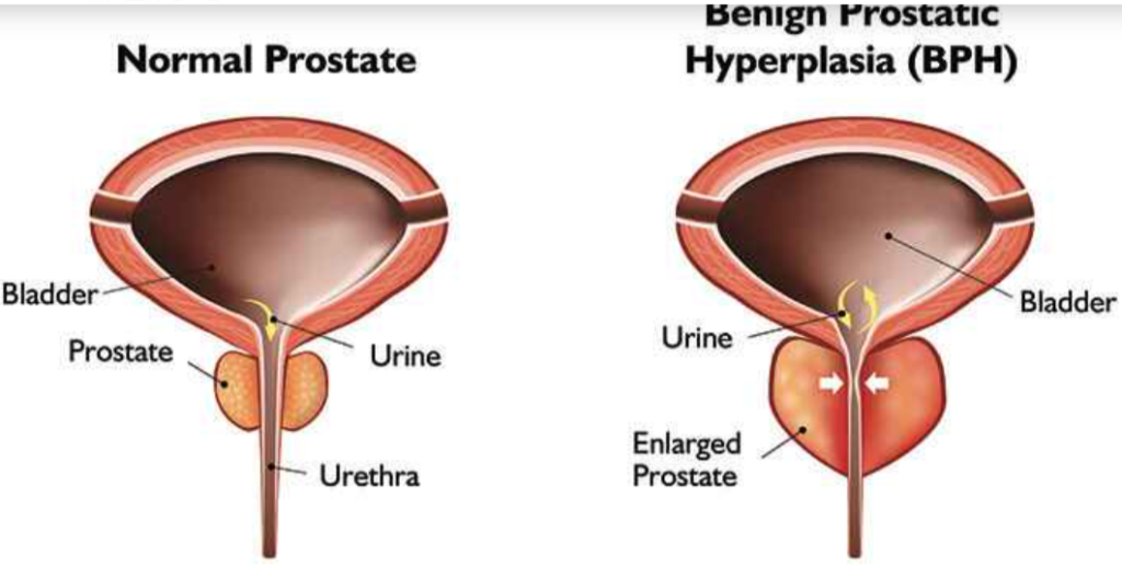 Benign Prostate Hypertrophy Treatment